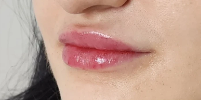 Close-up of a person's lips with glossy, pink lipstick, enhanced by subtle filler for added fullness.