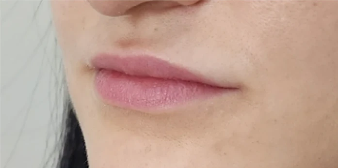 Close-up of a person's lips and lower face with natural, light pink lip color and smooth skin, showcasing subtle results of Botox and filler treatments.