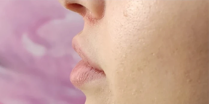 Close-up side view of a person's lower face, showing the nose, lips, and cheek with visible skin texture—highlighting areas often enhanced with Botox and filler.