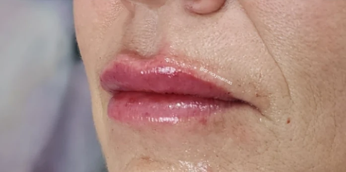 Close-up of a person's lips and chin with visible signs of aging, featuring glossy lips and subtle wrinkles around the mouth, hinting at the transformative touch of Botox or filler treatments.