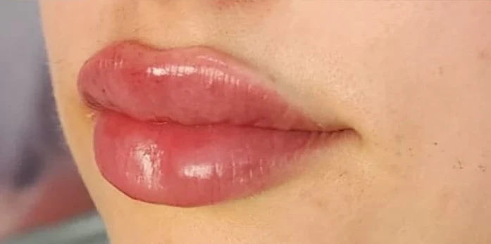 Close-up of a person's lips with noticeable swelling and gloss, possibly after a recent Botox or filler cosmetic procedure.