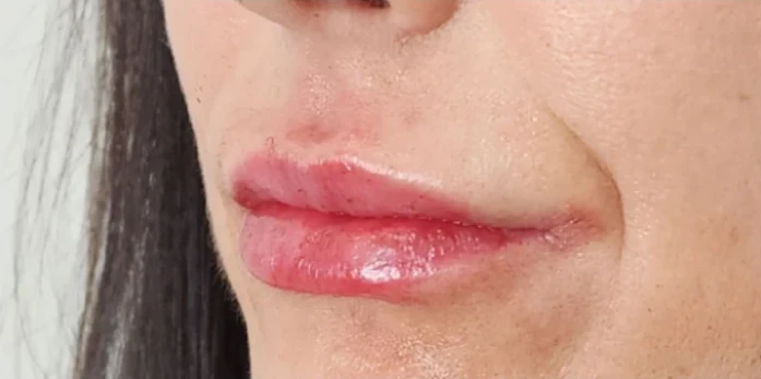 A close-up of a person's lower face reveals lips with a glossy finish, possibly enhanced by filler, and a small, visible burn mark above the upper lip.