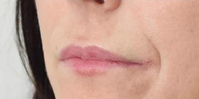 A close-up of the lower half of a person's face reveals lips and part of the chin, with a neutral expression hinting at the subtle enhancements that Botox or filler can offer.
