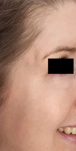 Close-up of the right side of a person's face, focusing on the eye area with the eye obscured by a black rectangle. Subtle signs suggest recent Botox and Filler treatments, while the person is smiling slightly.