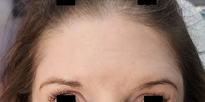 Close-up of a person's forehead and eyes, with black bars obscuring the eyes. The individual's smooth skin hints at a possible Botox treatment, while brown hair is neatly parted in the middle.